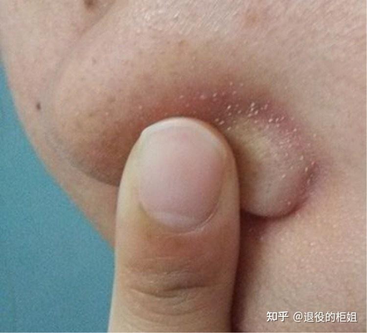 如何去脂质微丝