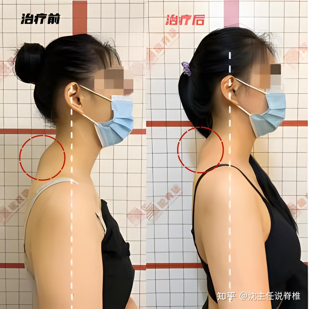 脖子后面鼓起来一个包 应该就是颈椎突出? - 知乎