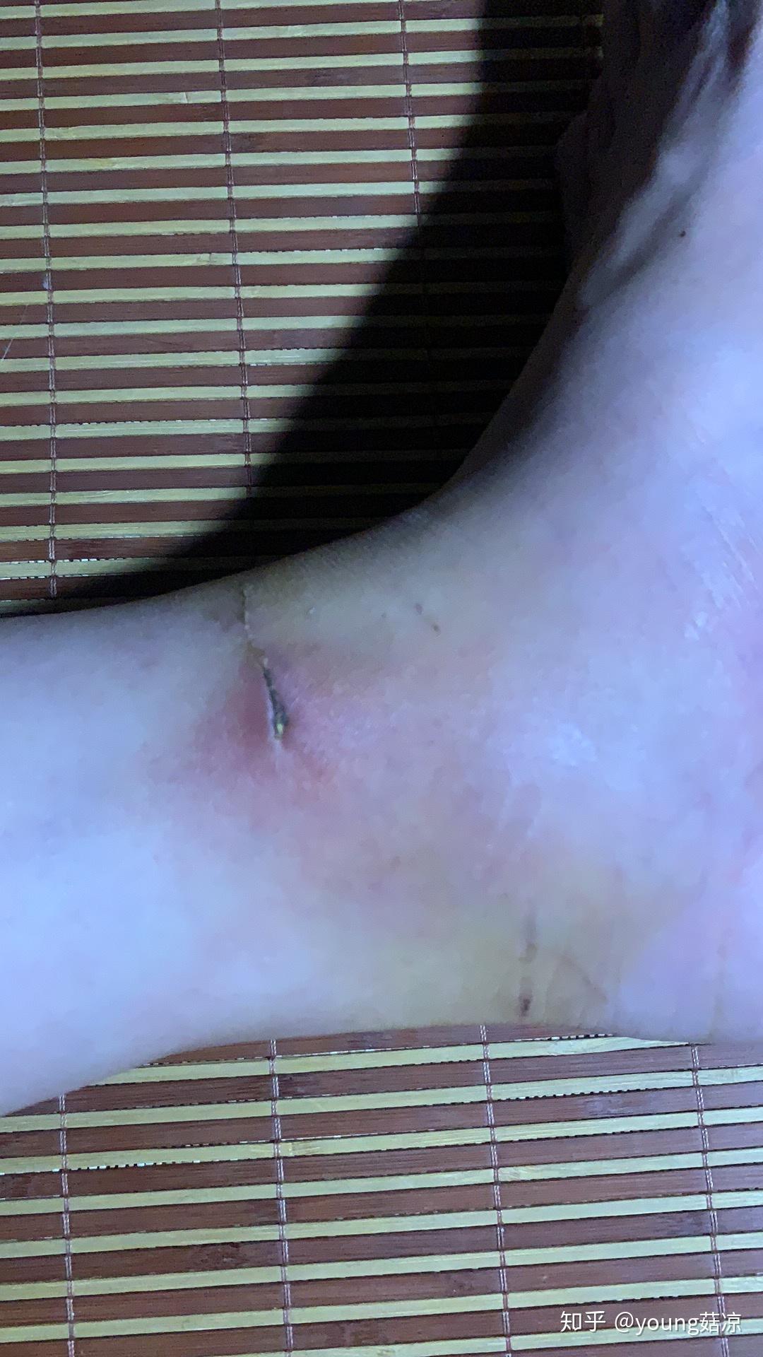 被自家猫咬了肿了一周它有多委屈