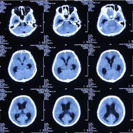 [圖-4]:2014-3-2患者入院時,發熱,意識模糊,頭痛伴嘔吐,腦膜刺激徵