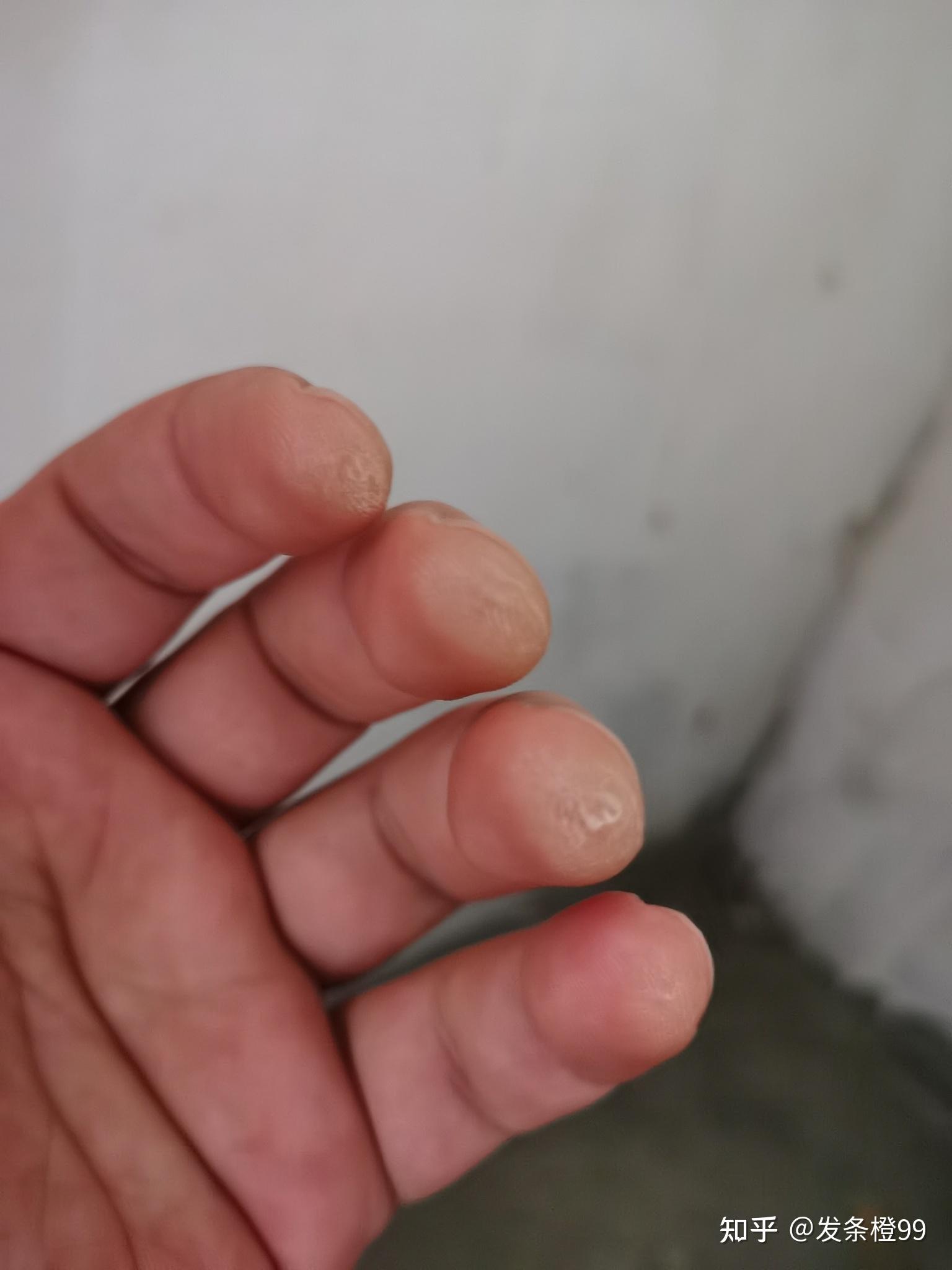 玩吉他的朋友可以拍一张左手手指上的茧吗