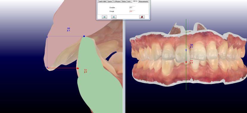 的协调比例头影侧位片测量分析㈩ 上下中线正;㈨  spee曲线深约3mm;㈧