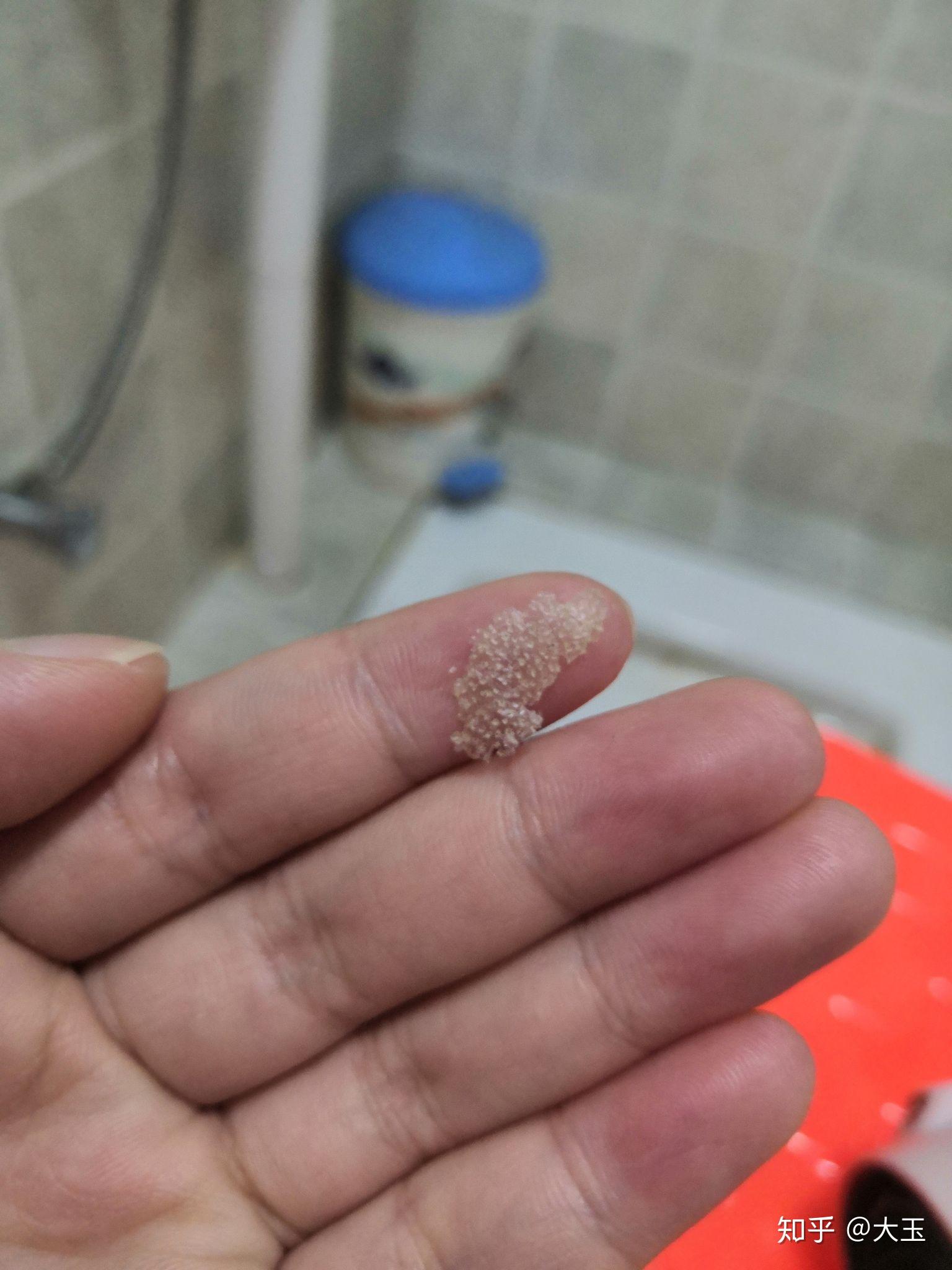 见过的最大头皮屑多大