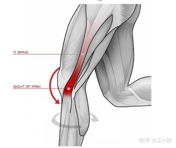 如何判断是否为髂胫束综合症附图
