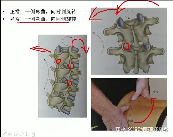 腰椎間盤突出相關肌肉力量失衡分析3