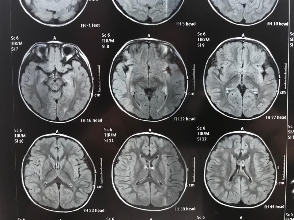 磁共振,双侧半卵圆中心及侧脑室后角旁白质异常信号,考虑扩大的血管