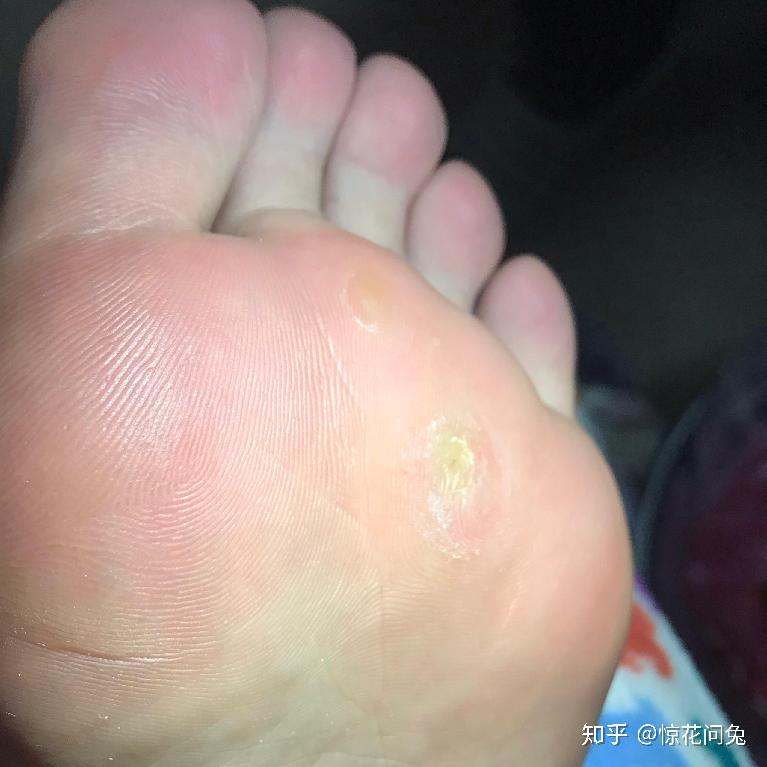 得了趾疣是一种什么样的体验怎么样才能治好