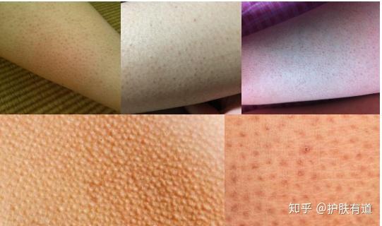 包含刮完胡子鸡皮疙瘩怎么消的词条