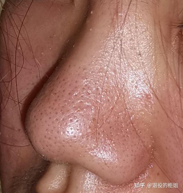 鼻子太多油了怎么办
