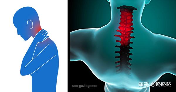 颈椎病初步认识 一 知乎