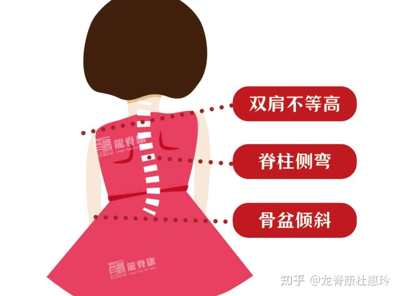 14岁女孩侧弯36°,矫正两年后减至17°,剃刀背15°减至5° - 知乎