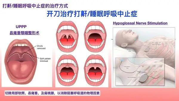 鼾症,俗称打呼噜 - 知乎