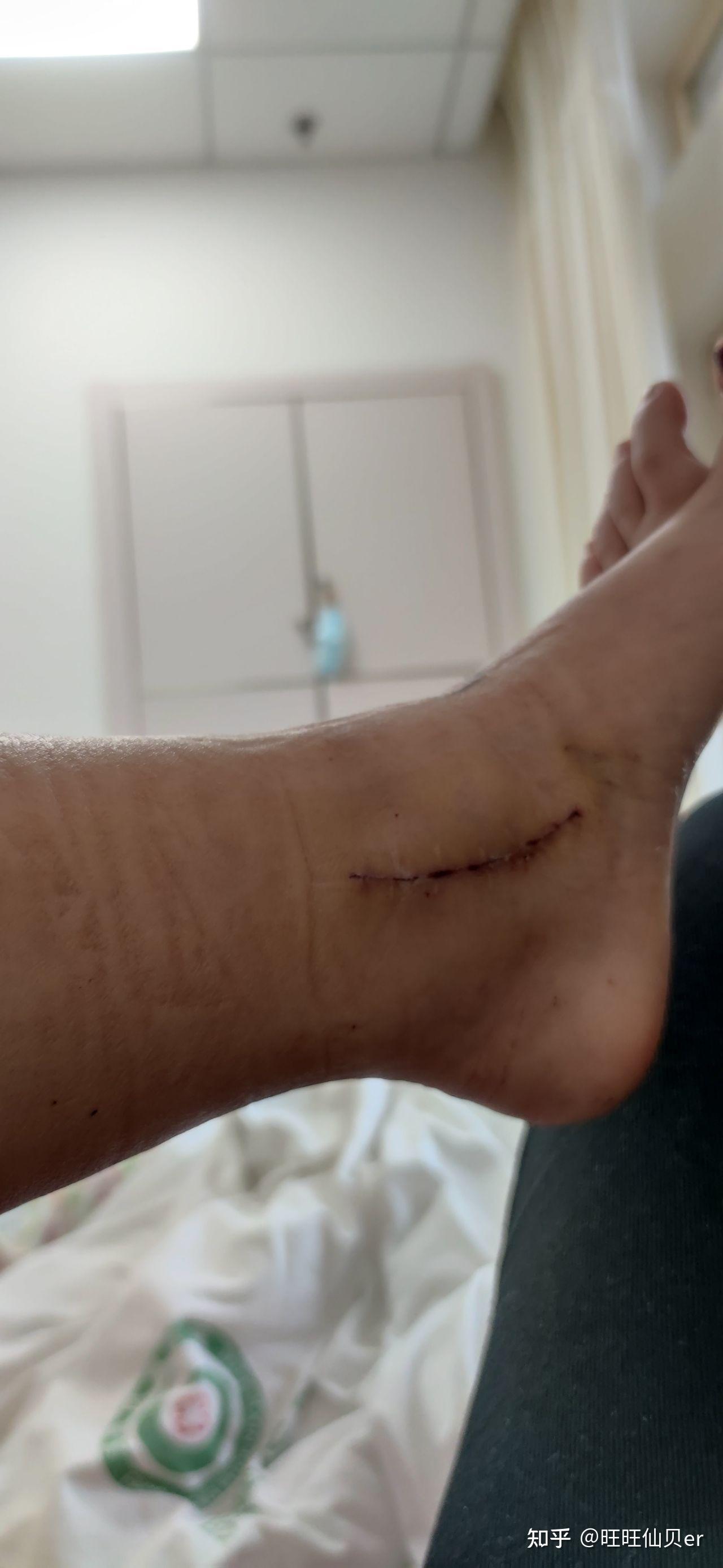 右内踝骨折术后取钢钉好取吗?