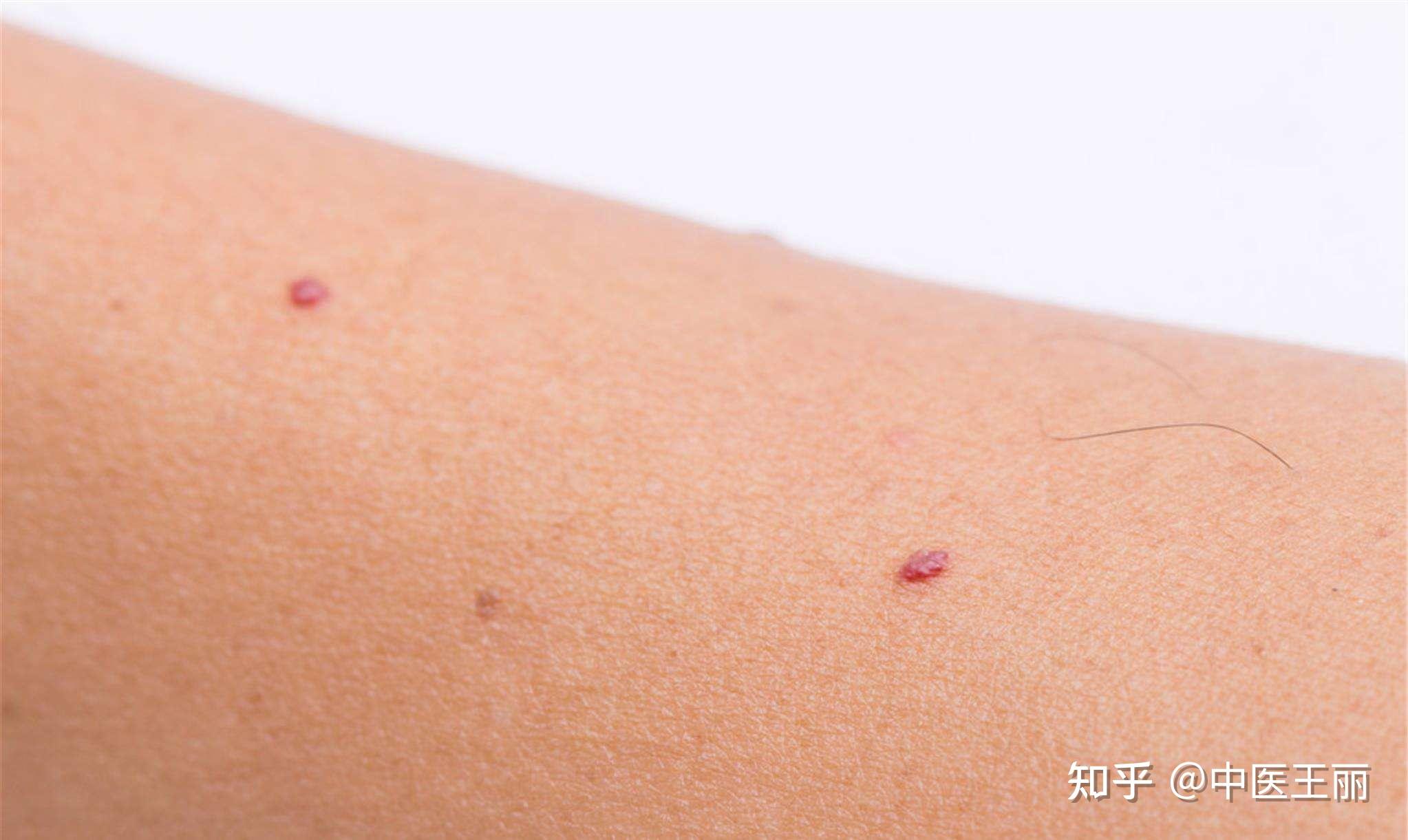 身上有个血红色像痣一样的痘痘