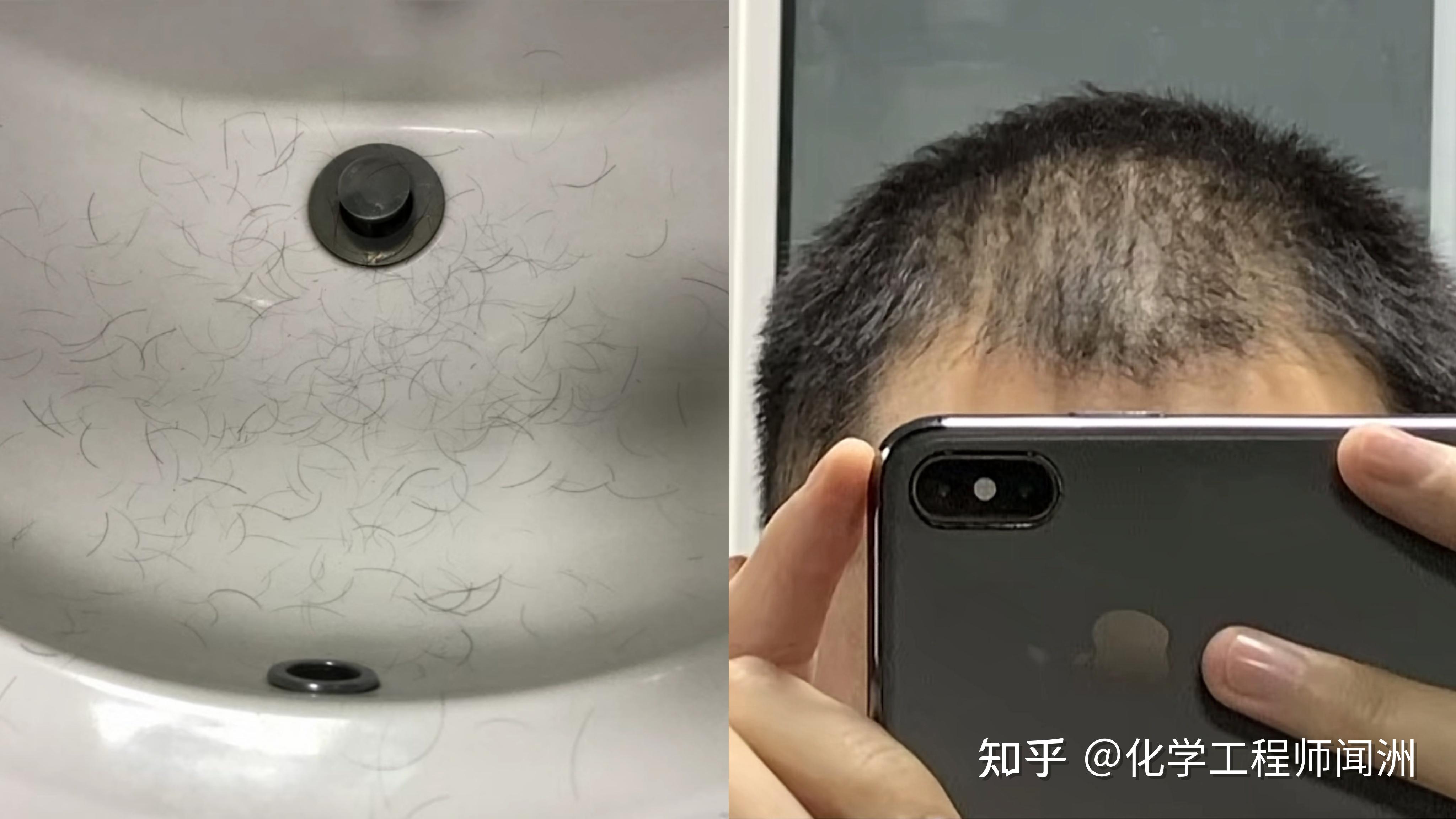 男生秃头怎么救？头发掉的都要秃顶了，有没有适合男生的防脱养发方法？【成分配方师】教你3步拯救秃头秃顶，实测2个月养出浓密秀发！ - 知乎