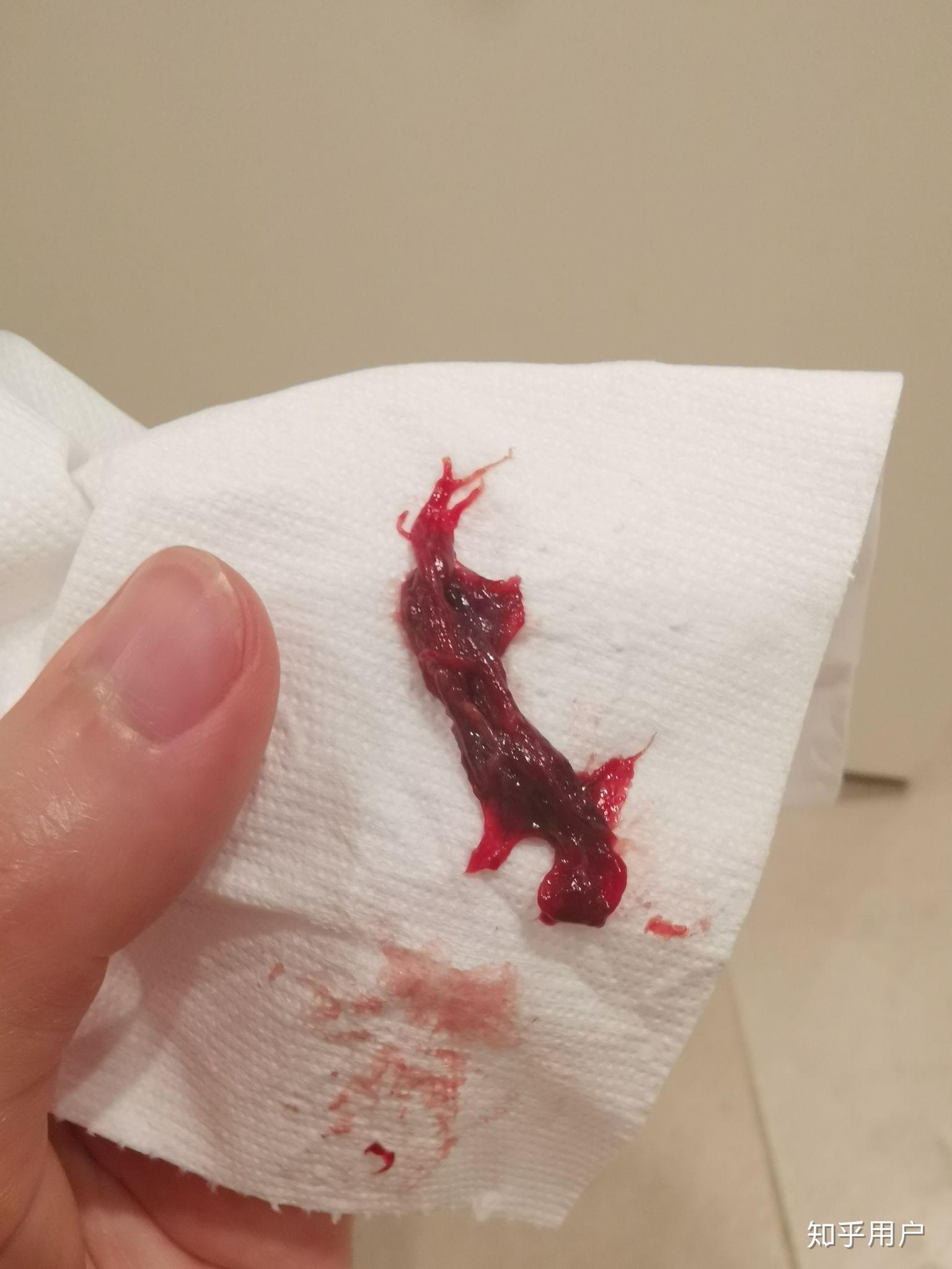 月经期为什么会排出类似小肉块的东西