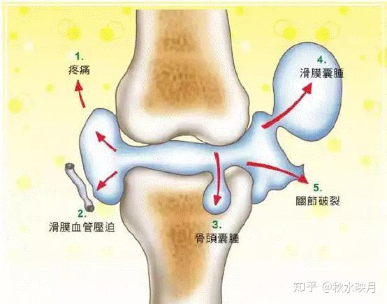 探讨专题 膝关节疼痛的起因及保养 知乎