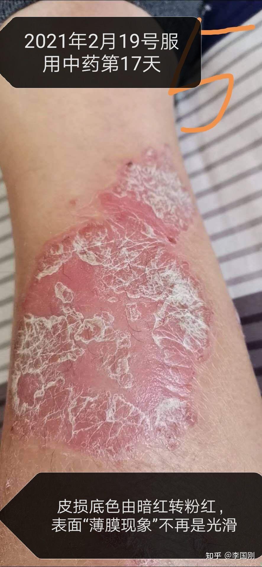 寻常型银屑病腿部块状消退过程图片(上) - 知乎