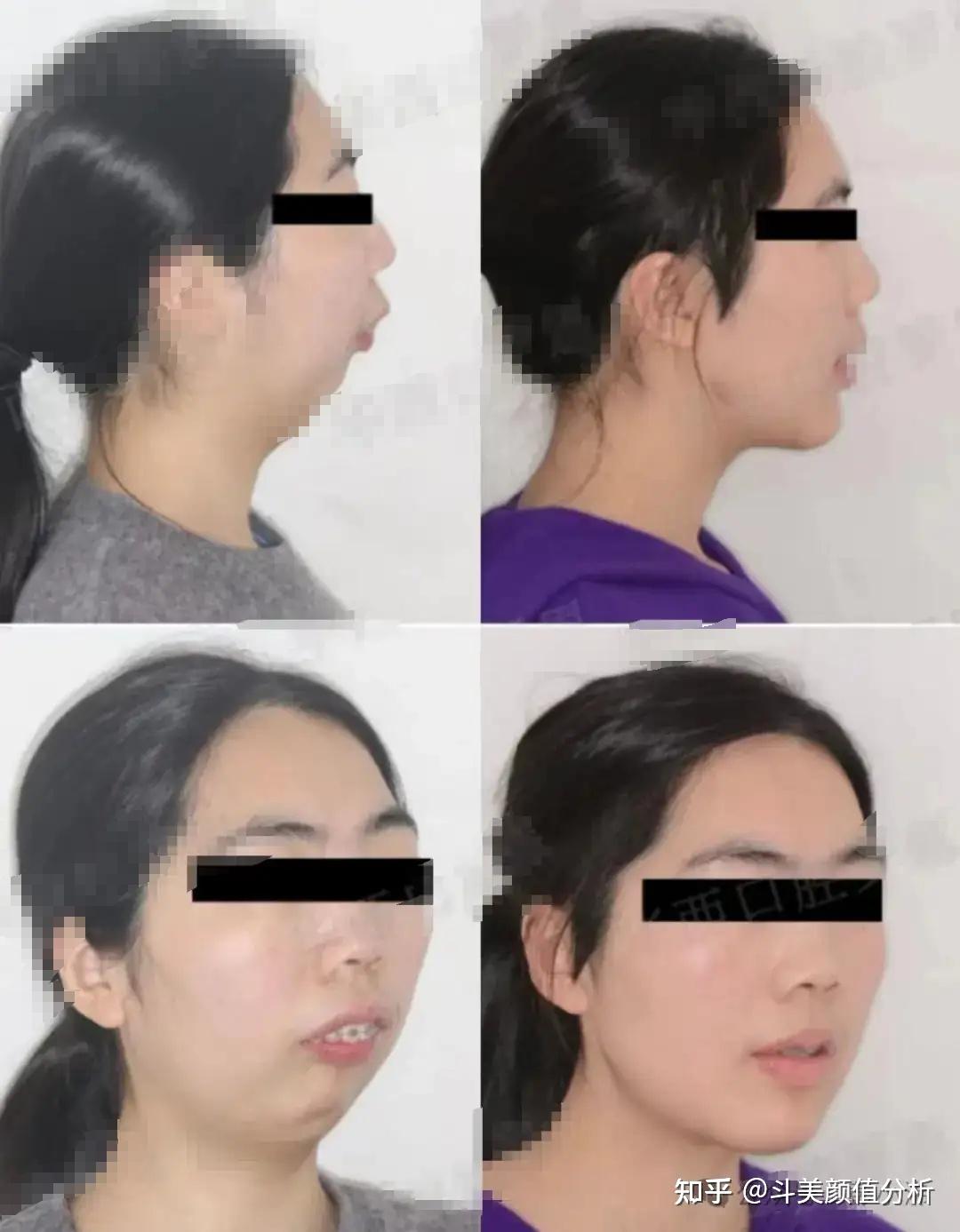 下巴后缩很丑怎么办?下巴后缩 …