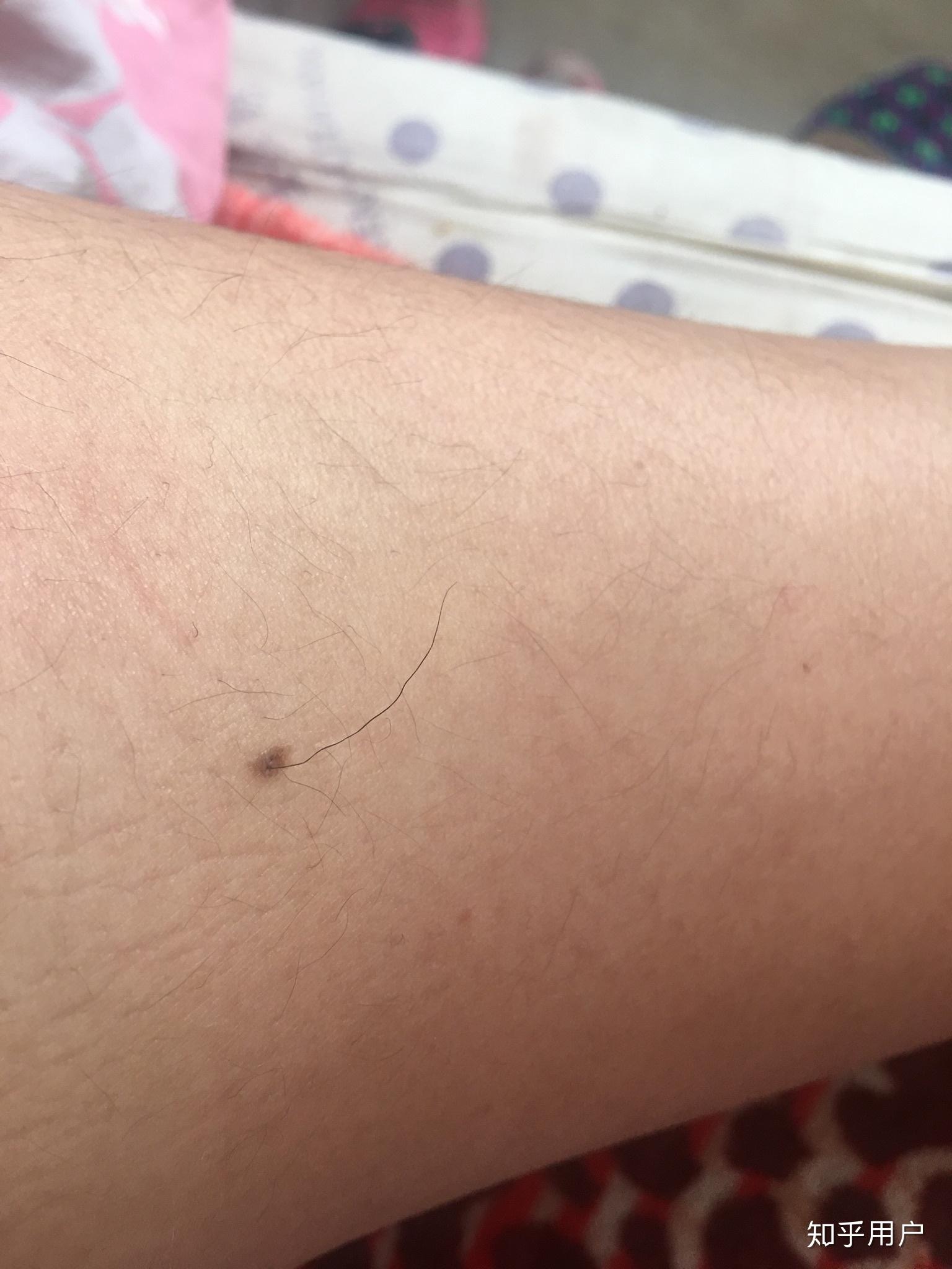 一般大痣上面会长根毛那么那根毛是因为巧合长在痣上还是属于痣的套装