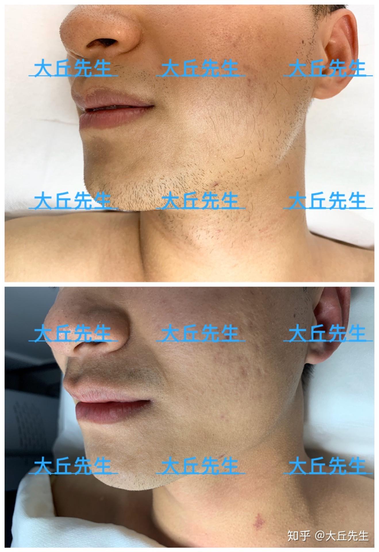 男性如何进行面部脱毛