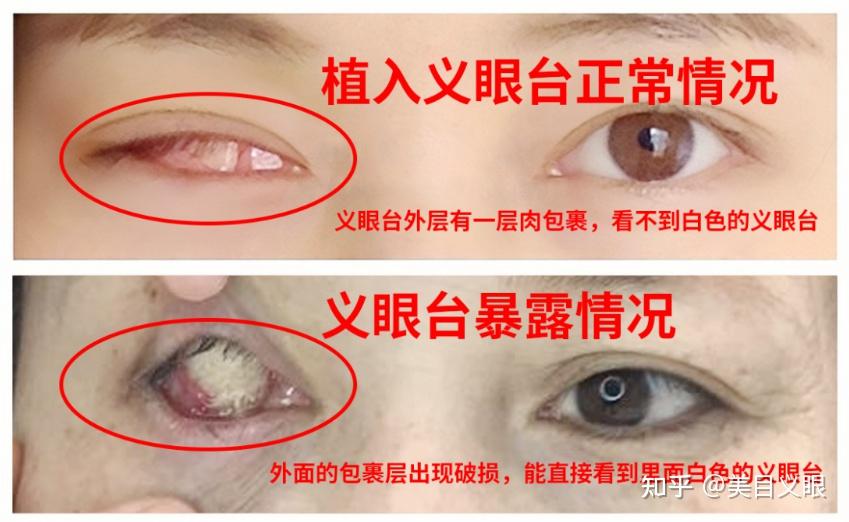 义眼台暴露后怎么办？还能戴义眼片吗？ - 知乎