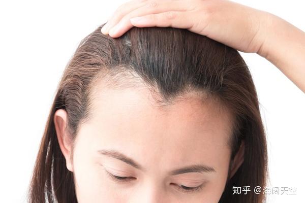 M型发际线与美人尖有何区别吗? - 知乎