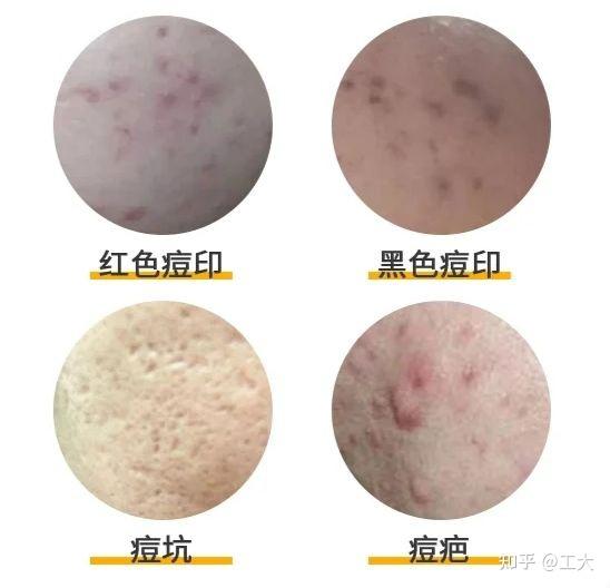 如何分辨红痘印，黑痘印，痘坑痘疤，正确有效祛痘印。 - 知乎