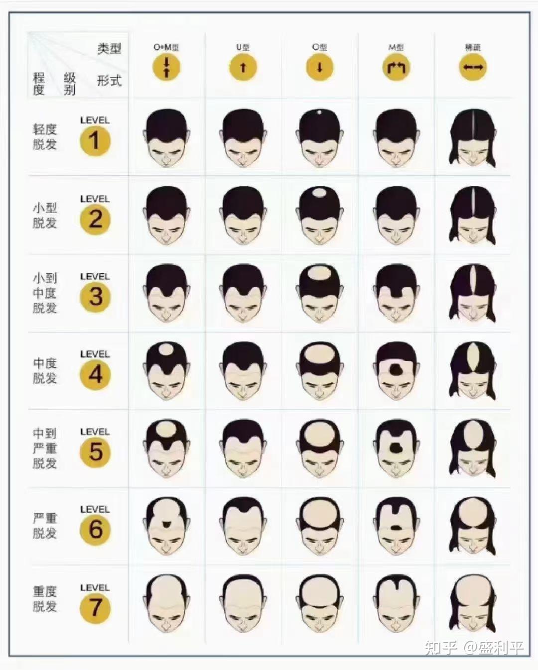 额角头发减少一定是雄脱吗? - 知乎