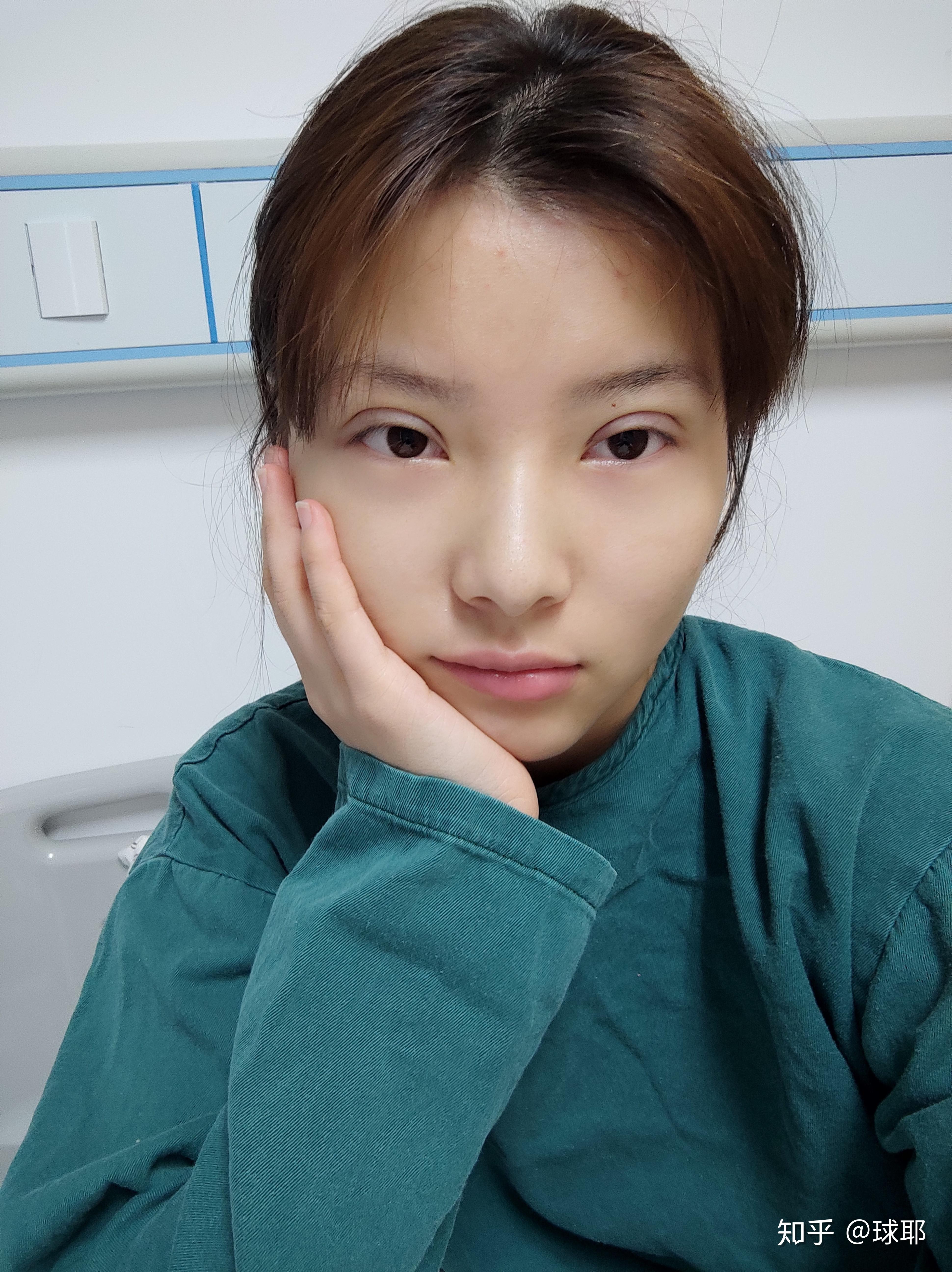 全切双眼皮术后一个月 两个眼睛大小不一样 一只眼睛还肿 - 知乎