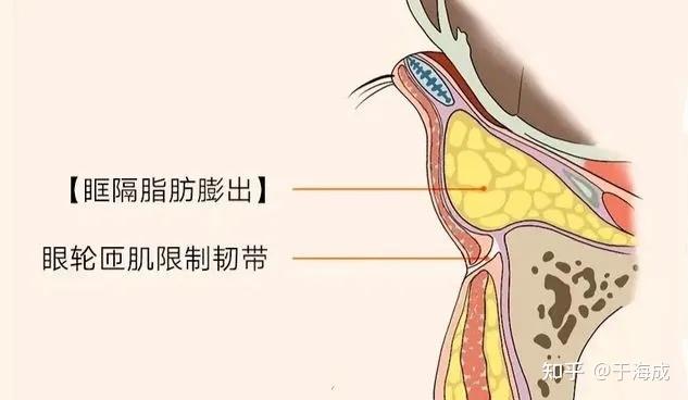 皮肤,眼轮匝肌,眶隔膜退变松弛及眶隔脂肪移位脱垂所致的下睑臃肿膨隆