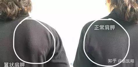 你以为很性感的蝴蝶骨竟然