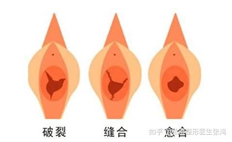 每个姑娘都会有处女膜吗并不是