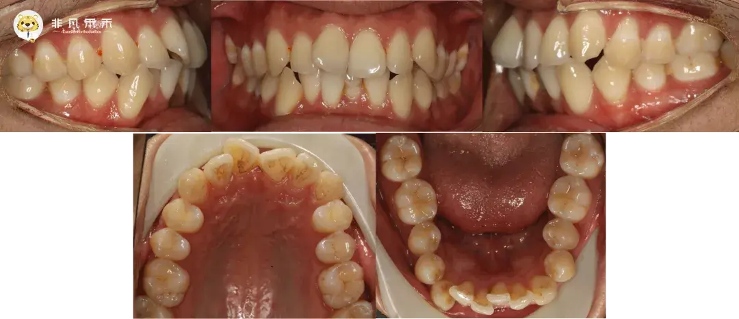 正畸病例牙突嘴突拔4个4病例一例