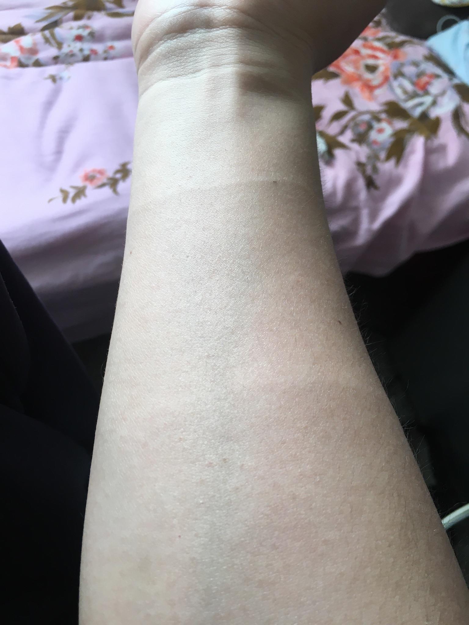 为什么很多人手臂上有一圈痕?