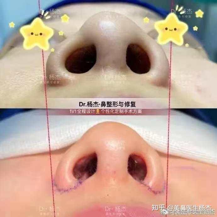 内外联合鼻翼缩小鼻翼缩小三段分法效果最优化