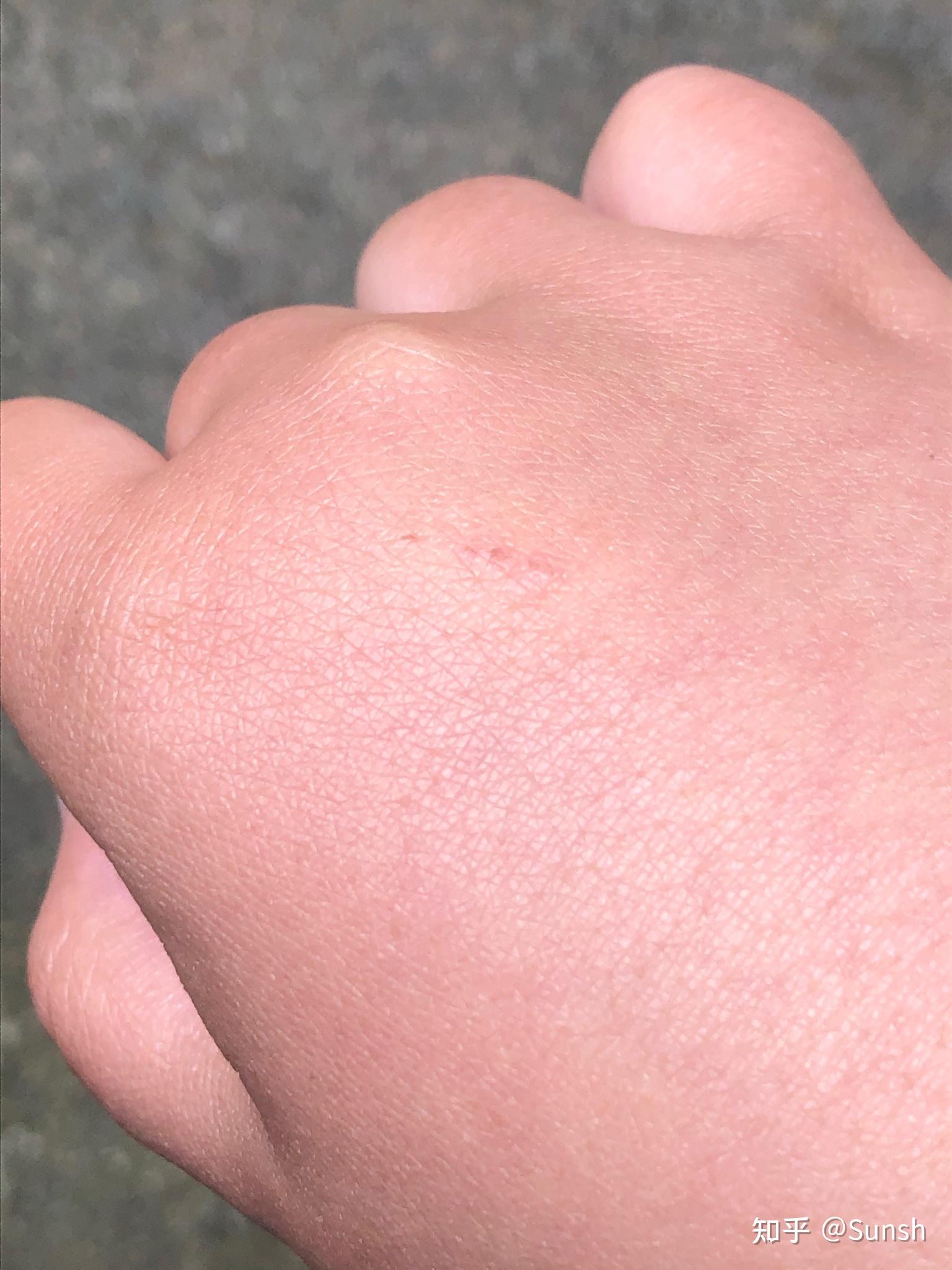 被猫抓伤要打针吗