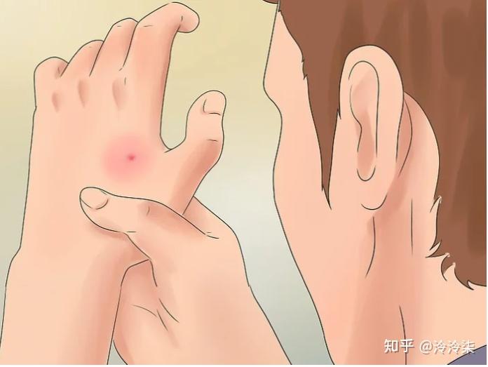 被蜘蛛咬了怎么办