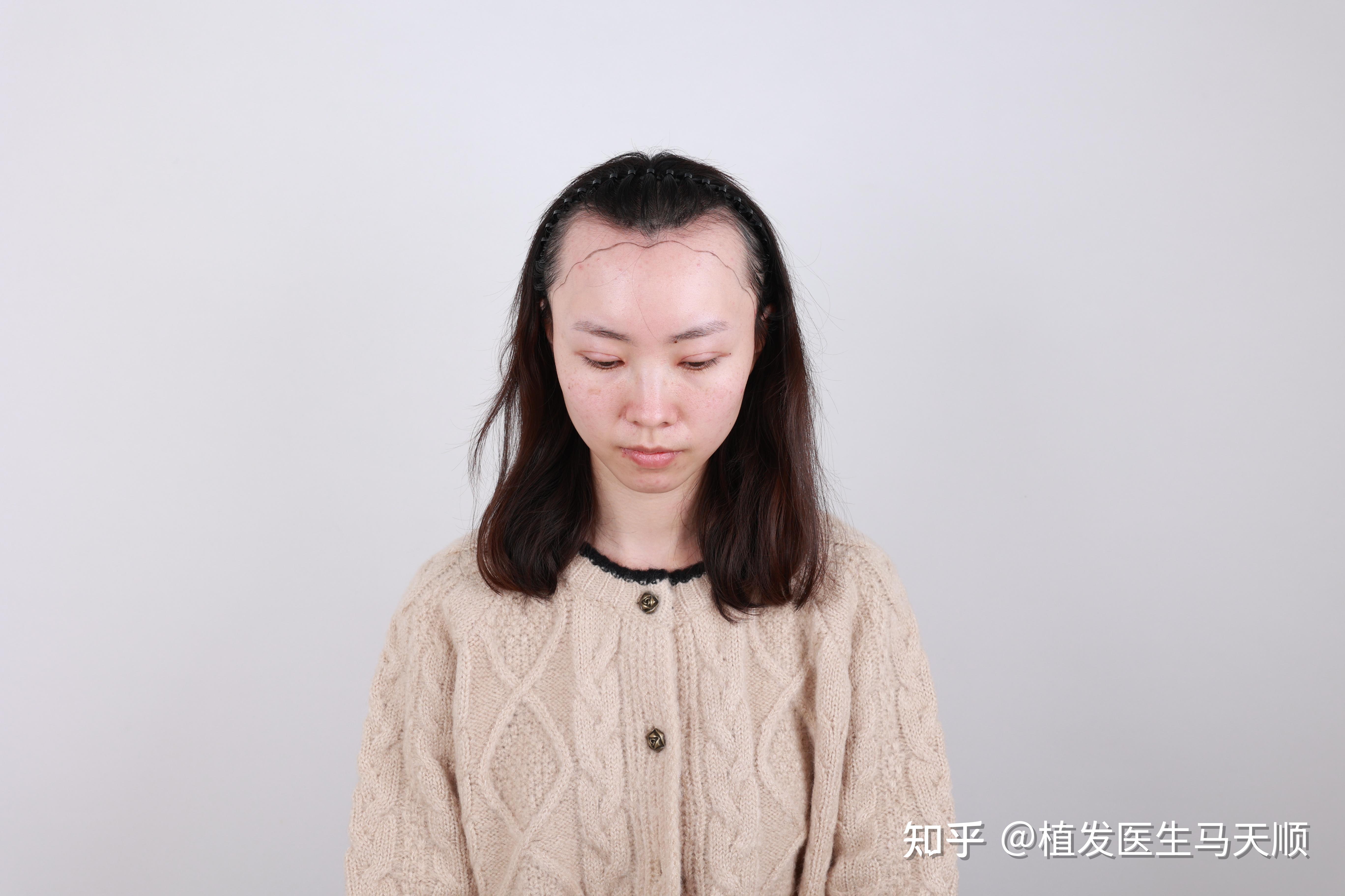随身植发(植发可以自带头发吗)