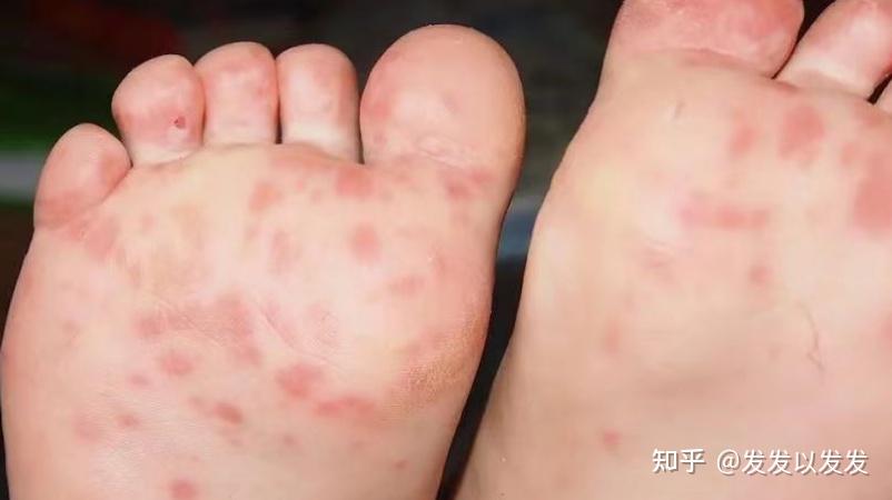 湿疹痱子手足口一招教你简单辨别