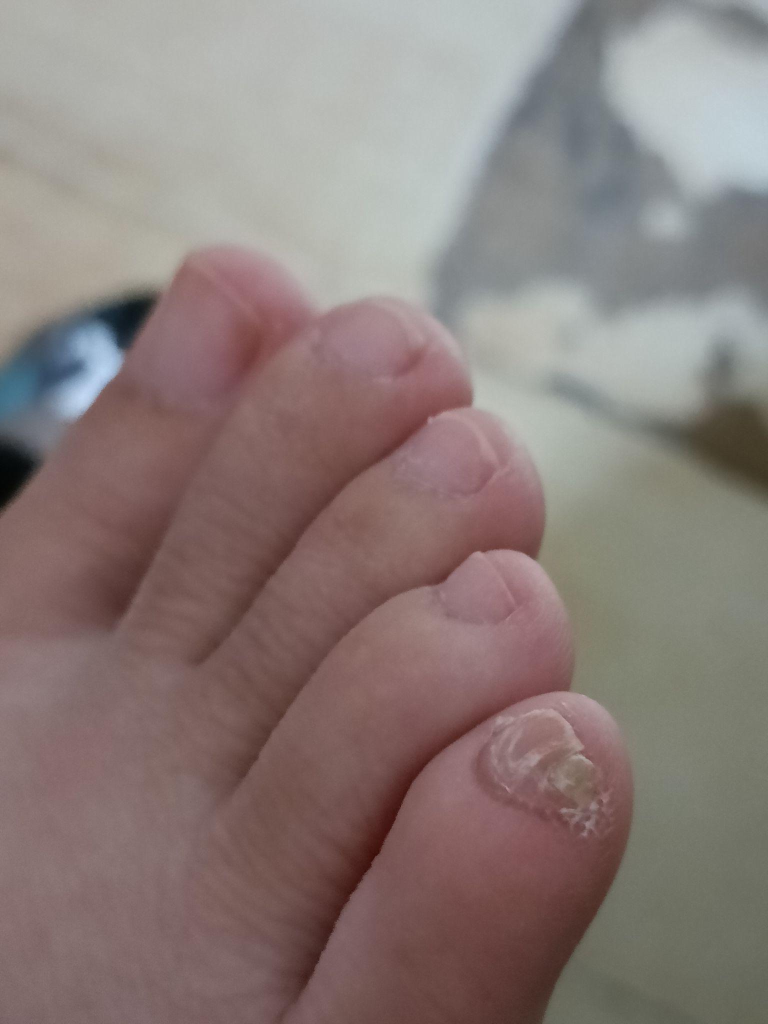 小脚趾的指甲特别难看怎么办? 