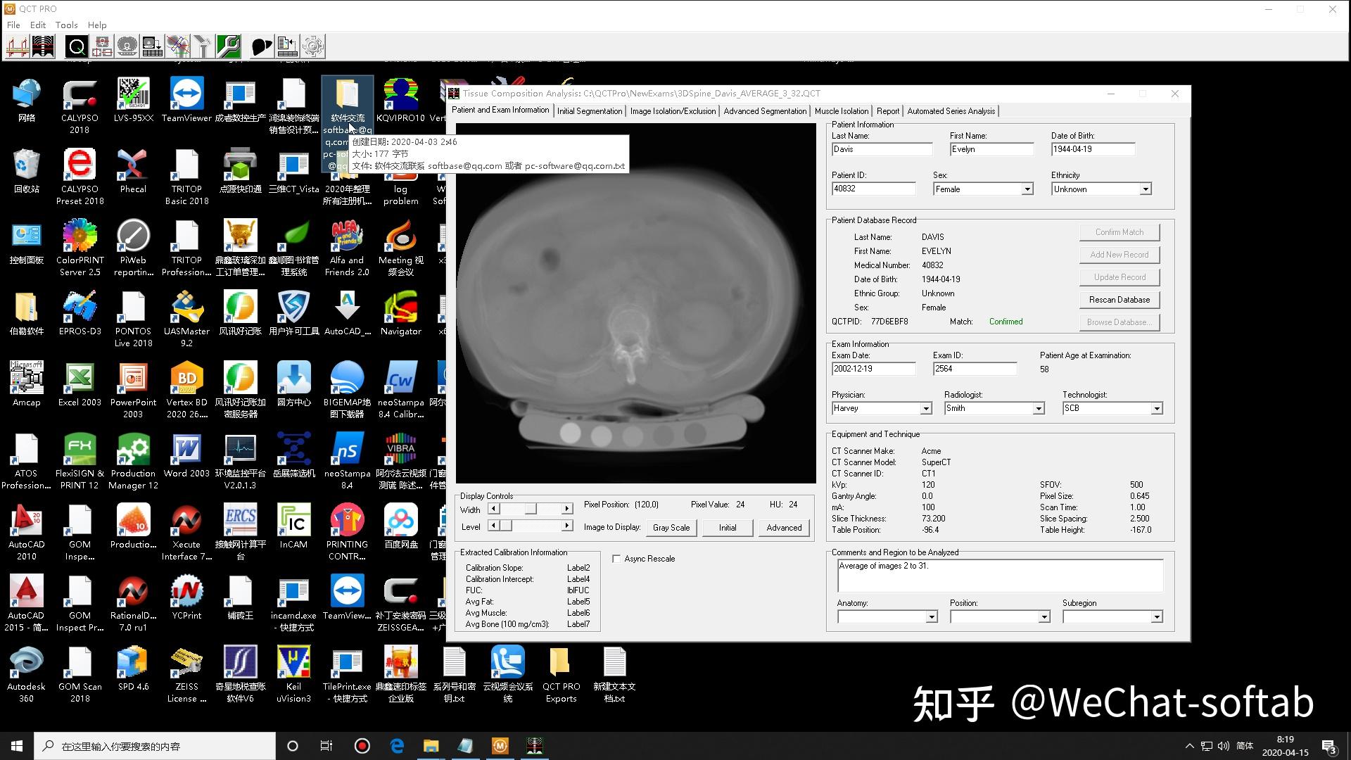 com/s/1sos0ogssi5_vf5l_ovof_a提取碼:xh4i前面分析了由於qct骨密度