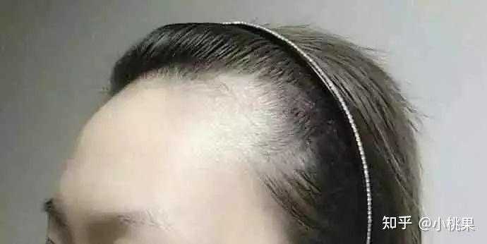发际线高怎么补救?教你12招挽救发际线! - 知乎