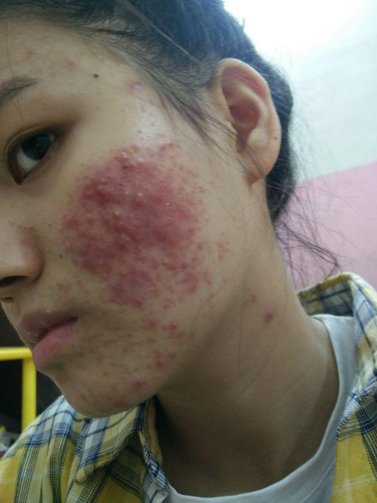 青春期长痘痘自卑,不想与别人交流怎么办? - 知乎