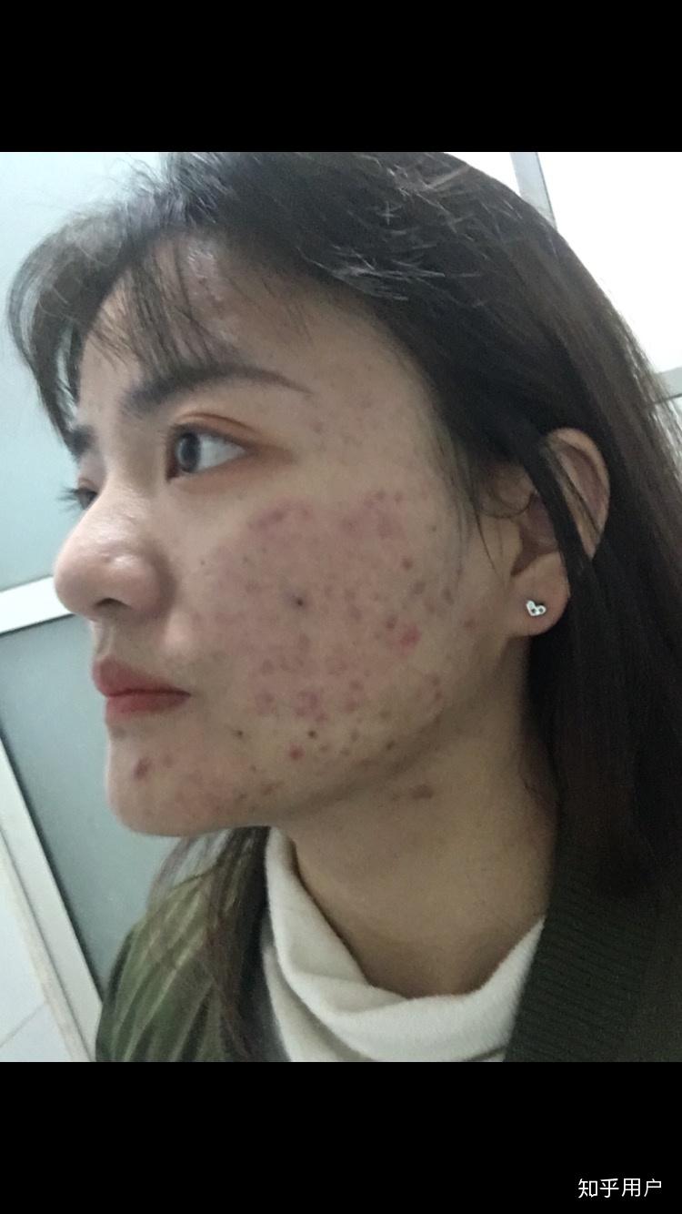 长得好看但是皮肤很差是一种怎样的体验?