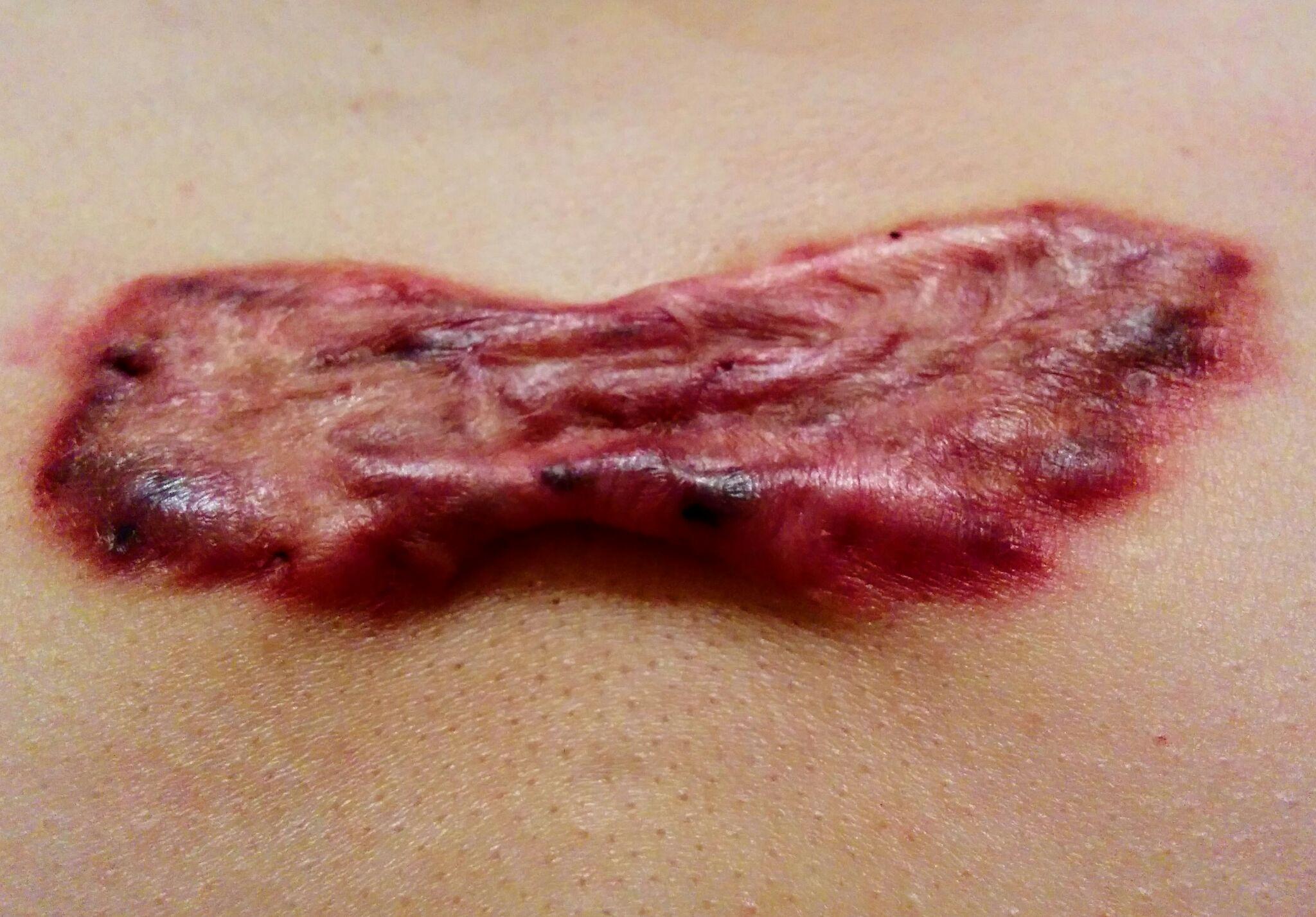 疤痕疙瘩内部图片