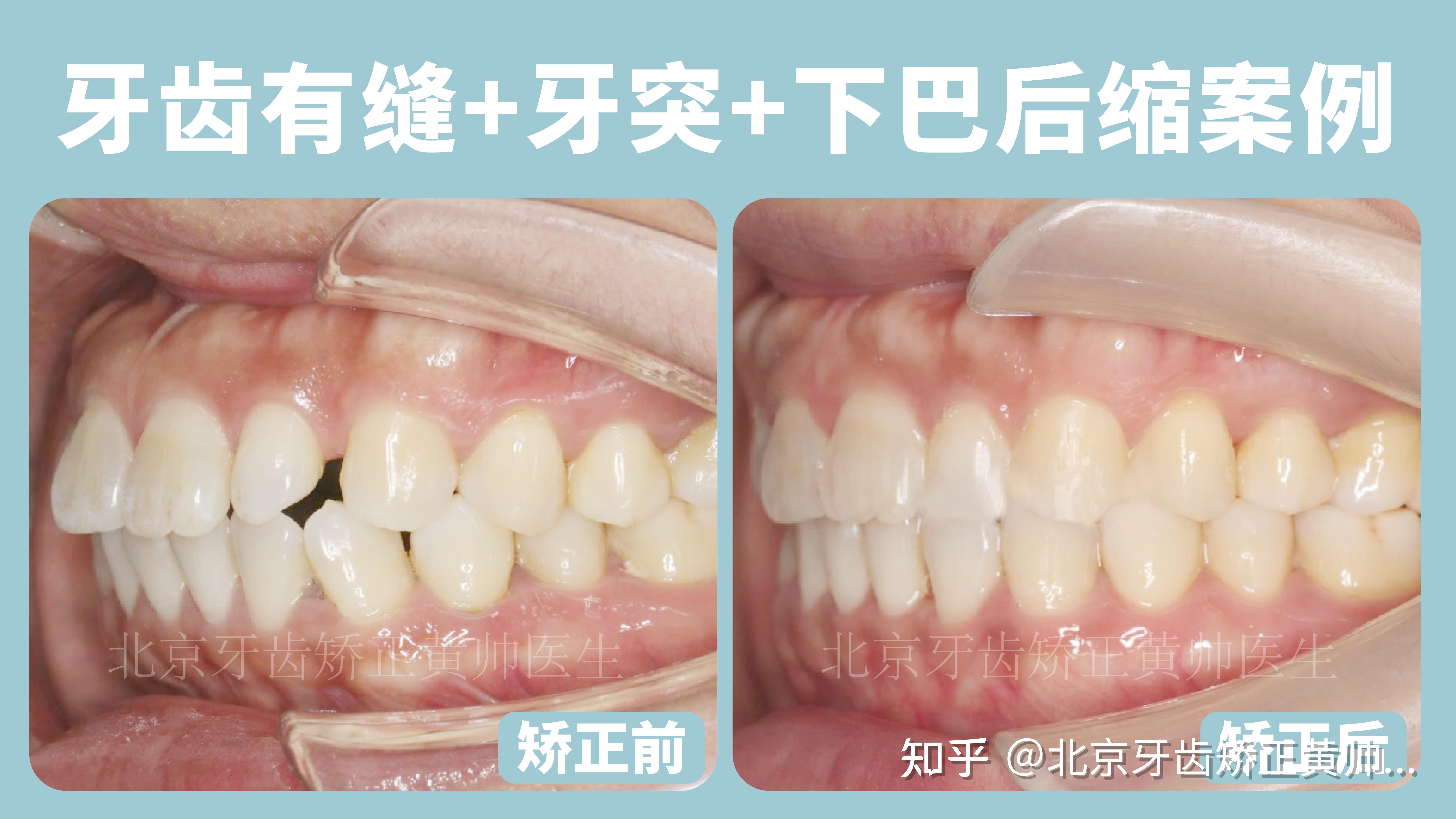 牙缝大,是选择牙齿矫正还是牙齿贴面? - 知乎