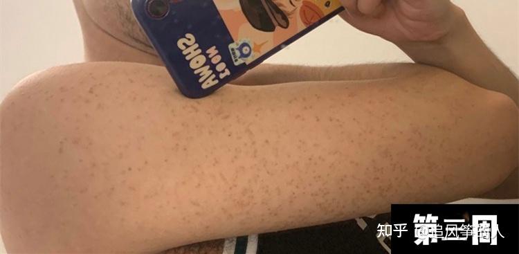 鸡皮肤身上不光(身上有鸡皮肤怎么回事) 鸡皮肤身上不光(身上有鸡皮肤怎么回事)