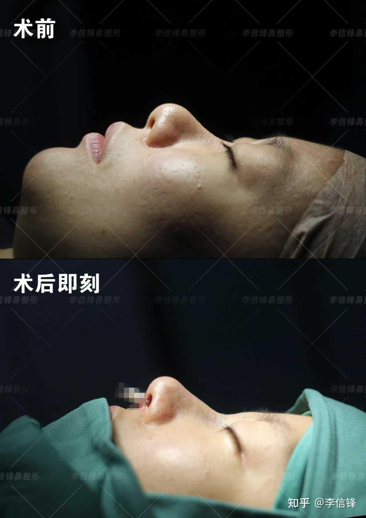 初鼻鼻综合-塌鼻梁、大鼻头改善案例,术后即刻对比~ - 知乎