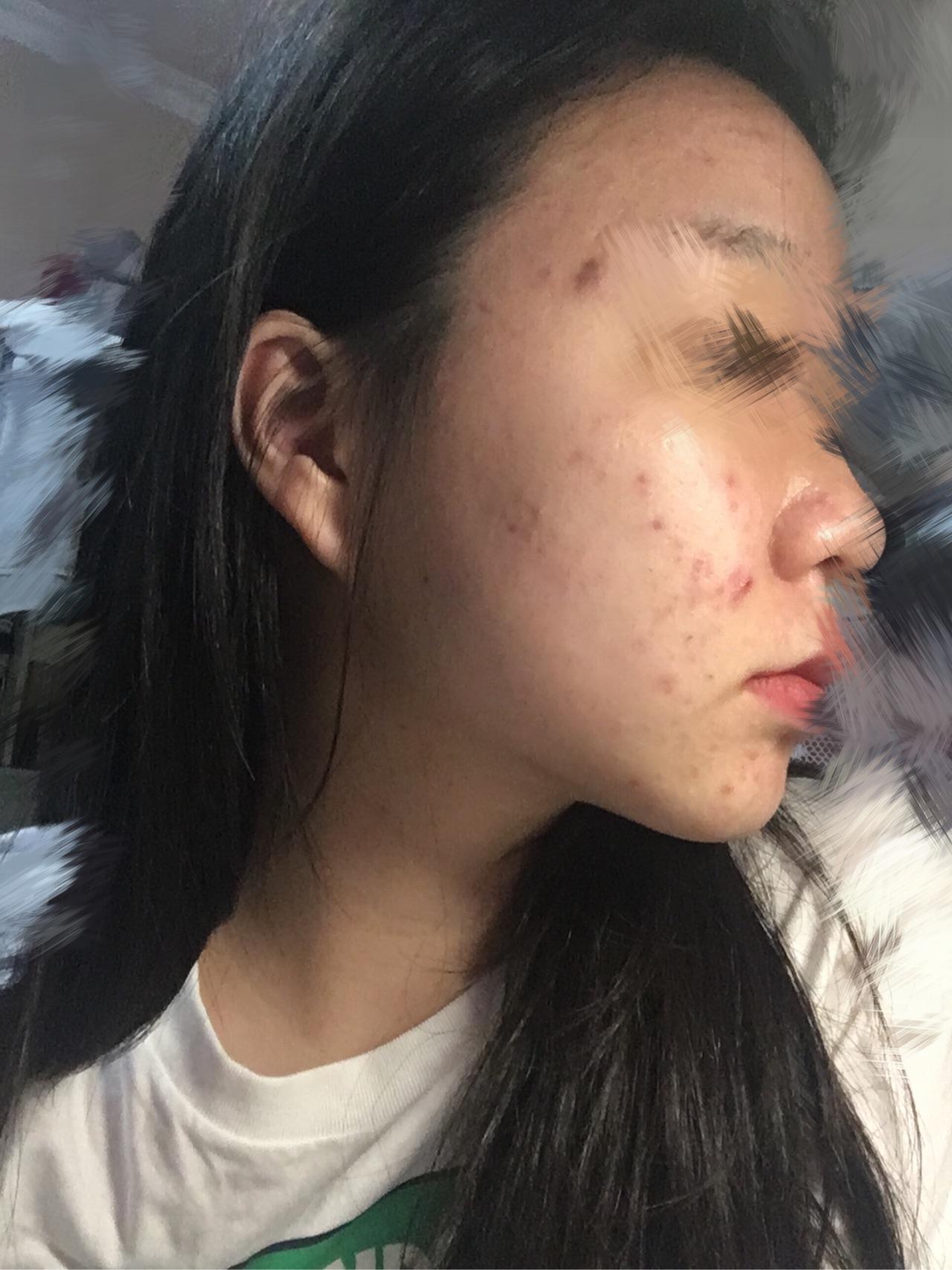 痘痘没了,留下痘印痘坑怎么办? - 知乎